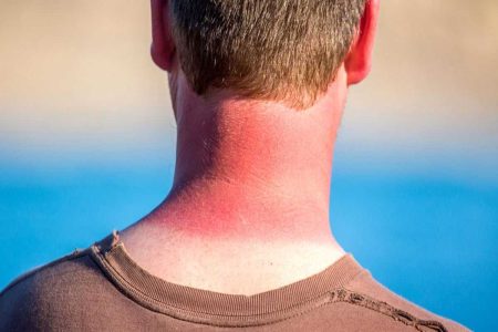 چگونه پوست آفتاب سوخته را تسکین و درمان کنیم؟