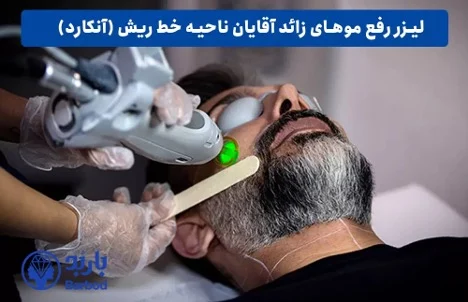 لیزر موهای زائد آقایان در تهران با جدیدترین تکنولوژی
